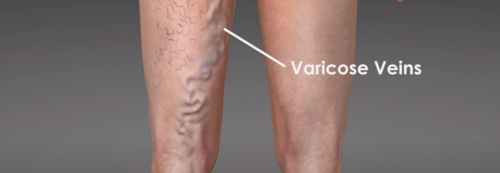 varicose vein disease