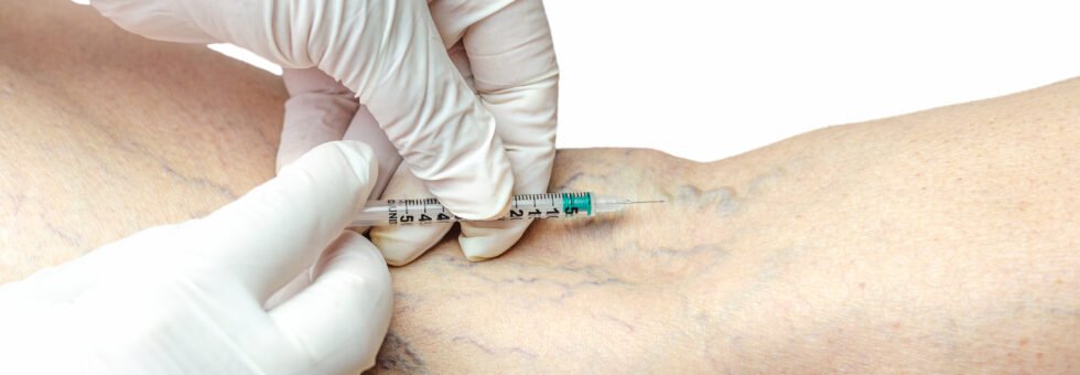 vein injection sclerotherapy