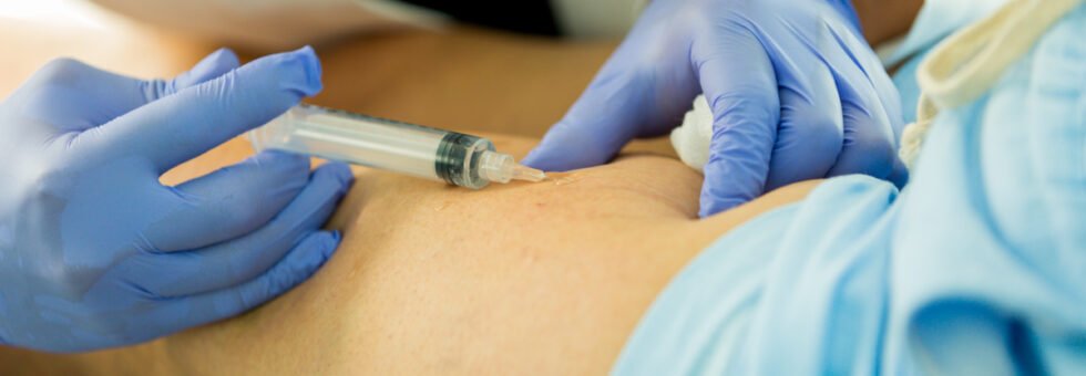 Vein Injection Sclerotherapy for Better Vein Health