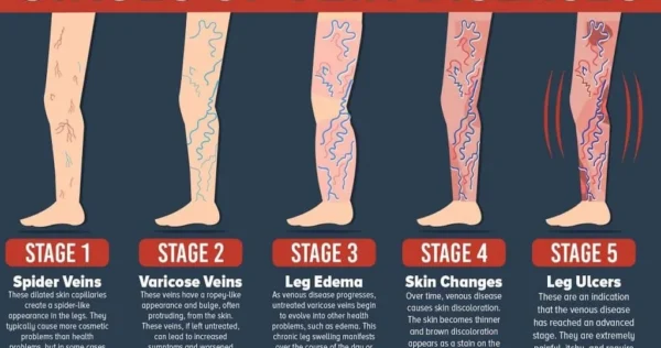 Stages of Vein Diseases