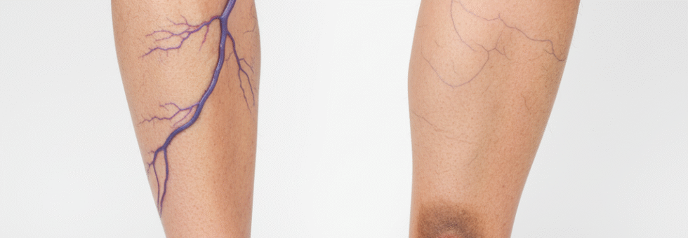 When to worry about varicose veins