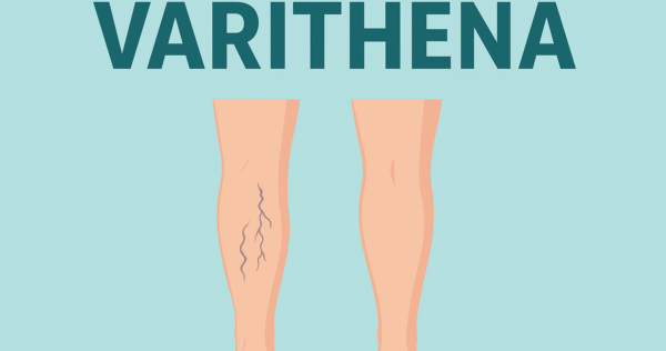 Varithena Procedure, Side Effects & Patient Reviews